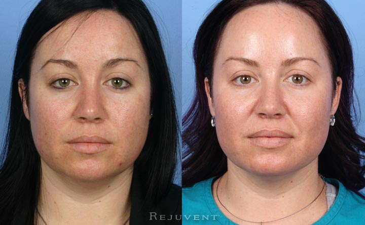 Peels, Fotofacial, Rejuvapen