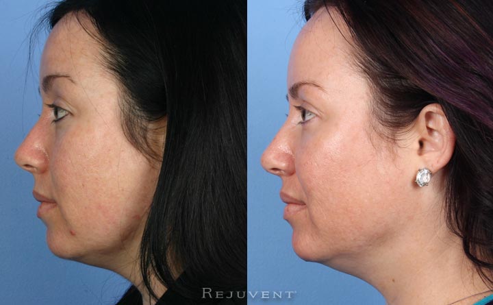 Peels, Fotofacial, Rejuvapen