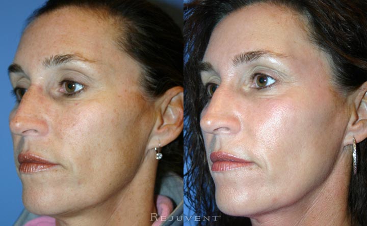 FotoFacial IPL Rejuvapen Microneedling  Pigment and Skin Improvement