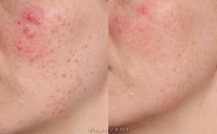 Rosacea and Redness Reduction at Rejuvent