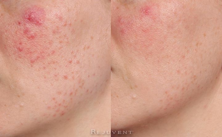 komponent Adelaide Plakater Rosacea Treatment • Rejuvent Medical Spa Scottsdale