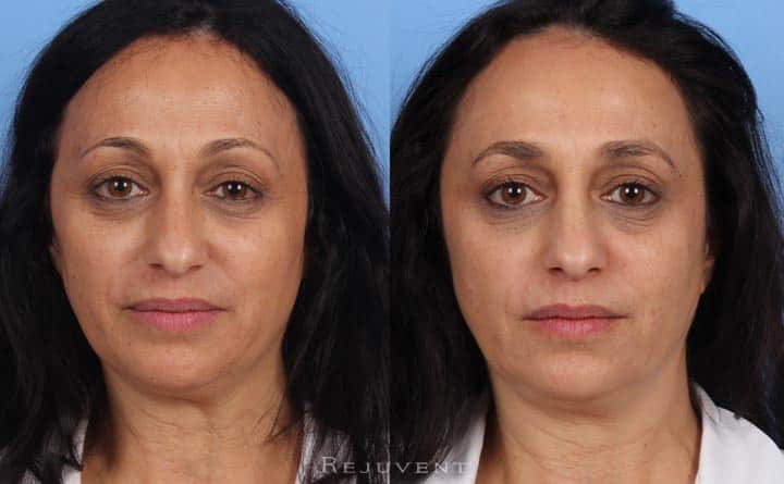 Fotofacial, Chemical Peels, Skincare Texture
