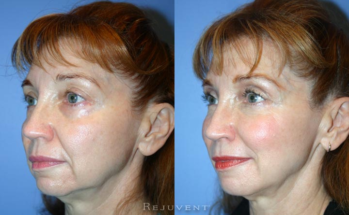 Volumizing filler under eye rejuvenation