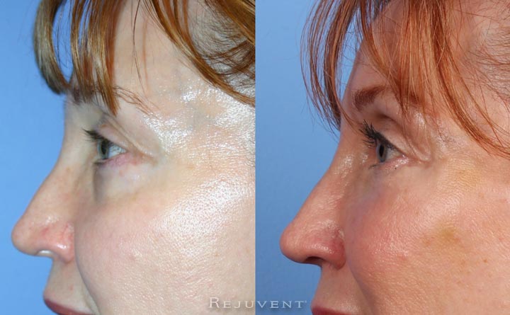 Under eye rejuvenation with Perlane