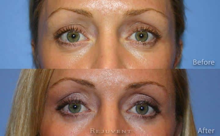 Lower eyelid surgery at Rejuvent Scottsdale