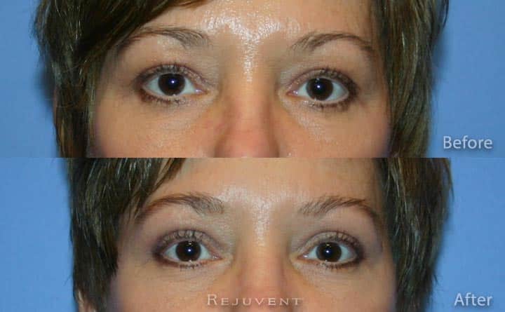 Upper Bleph Eyelid Surgery Rejuvent Scottsdale
