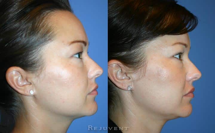 Upper eyelid surgery Rejuvent Scottsdale