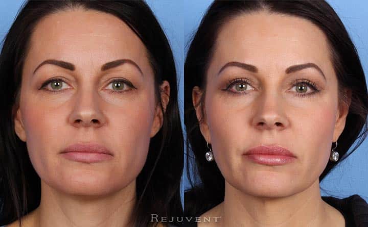 Upper and Lower eyelid surgery at Rejuvent, Scottsdale.