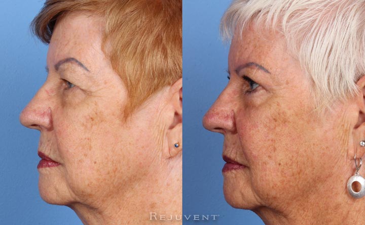 Upper - Lower blepharoplasty in Scottsdale AZ