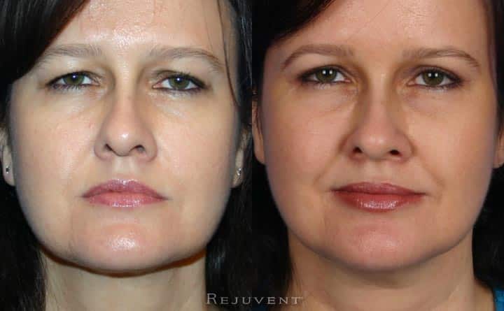 Upper Belph eyelid surgery at Rejuvent