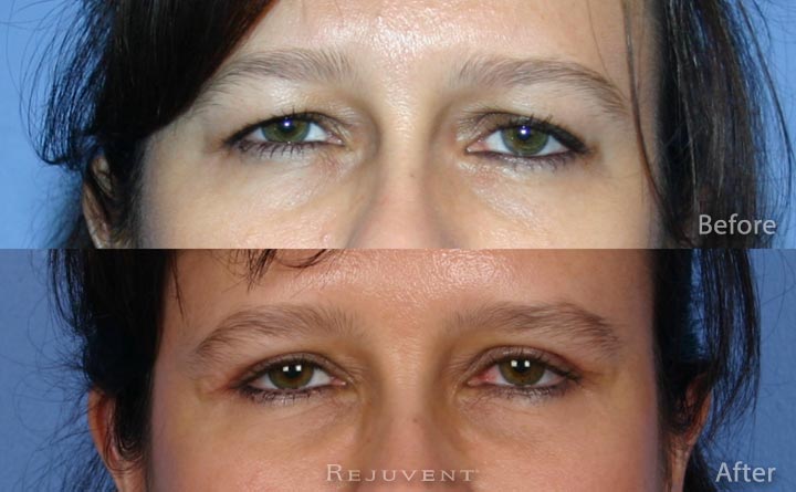 Upper Bleph eyelid surgery eyes view