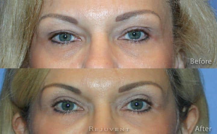 Upper eyelid surgery Blepharoplasty