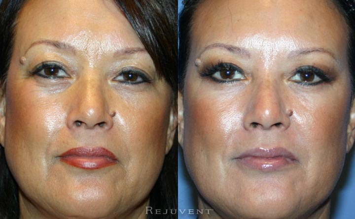 Upper Bleph Before and After Patient Rejuvent Scottsdale