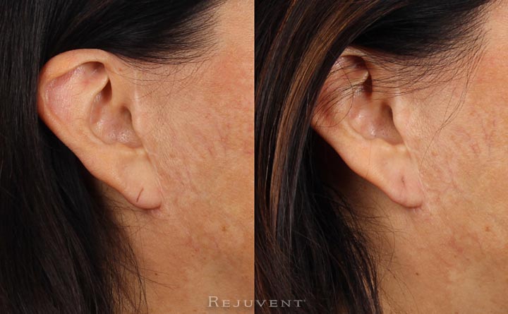 Torn Earlobe Repair Performed at Rejuvent Scottsdale