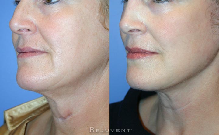 Scar revision and facelift