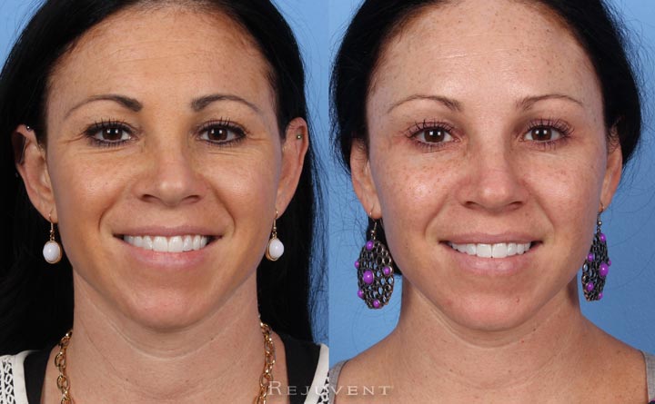Botox and Dysport before and after at Rejuvent Scottsdale