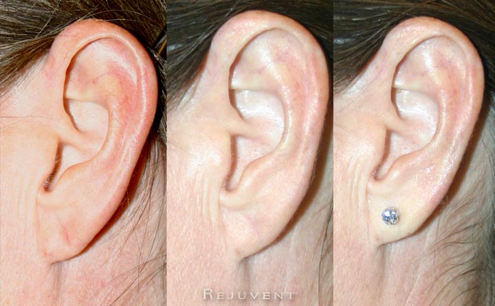 stretched earlobe repair surgery