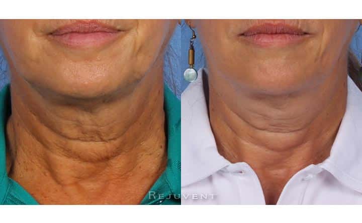 Neck skin firming