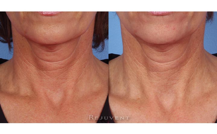 Neck skin firming with Nectifirm