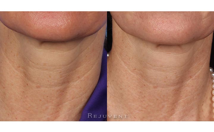 Softer Neck lines with Nectifirm