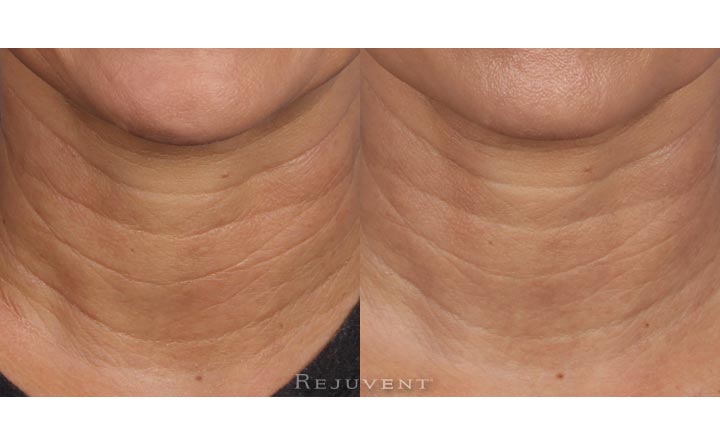 Skin firming and wrinkle softening with Nectifirm