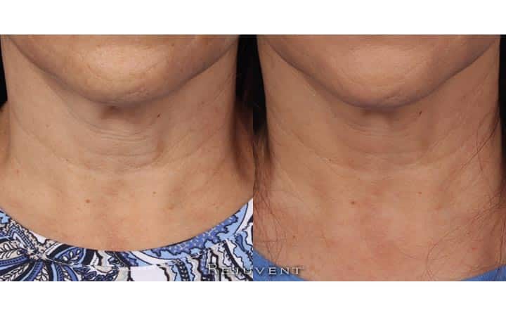 Neck firming - Patient used Nectifirm
