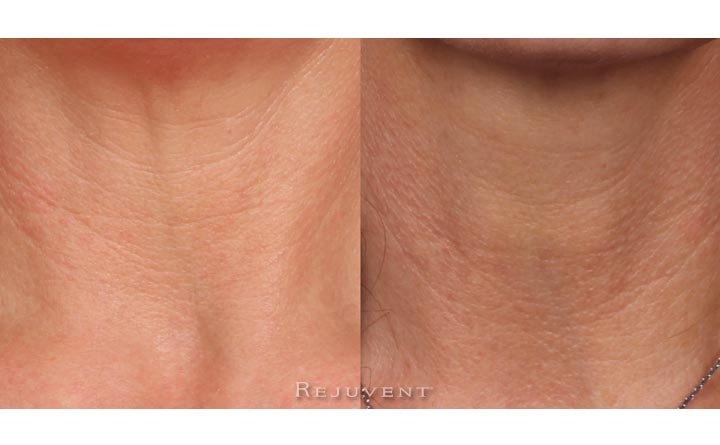 Neck Firming Photo 3 weeks use