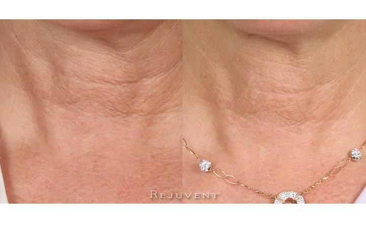 Neck firming - Female Patient used Nectifirm