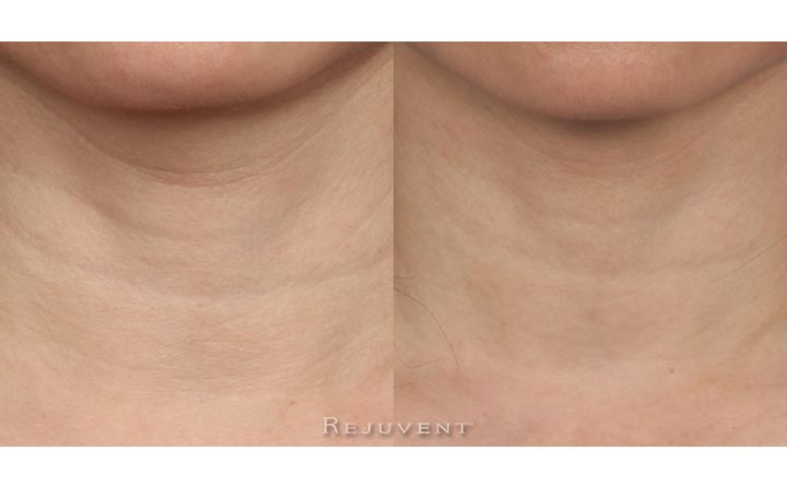 Neck firming Skincare