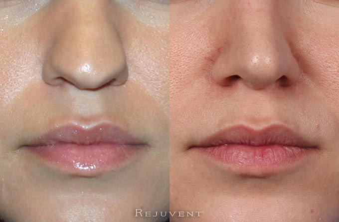 Rhinoplasty Results • Rejuvent Medical Spa Scottsdale