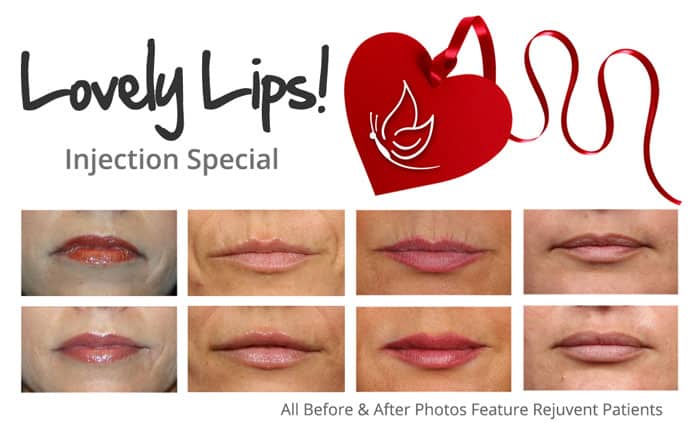 lovely-lips-filler-special