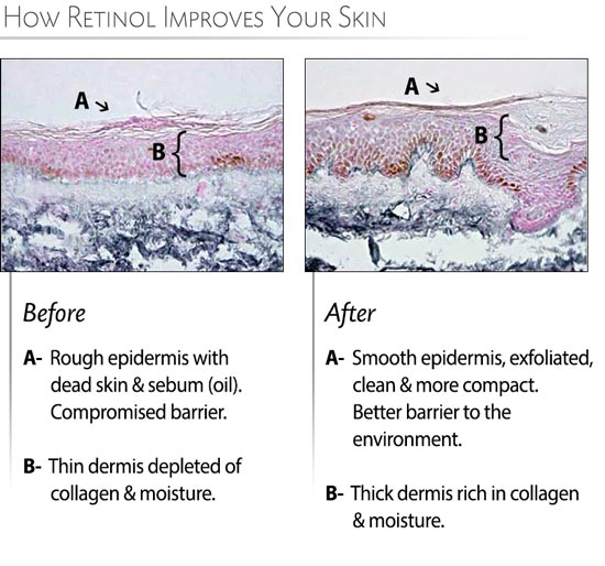 Dermis after Retinol use