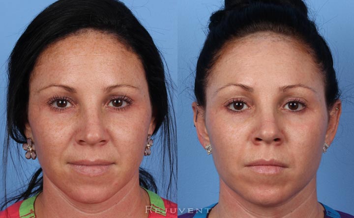 Fotofacial Great Results