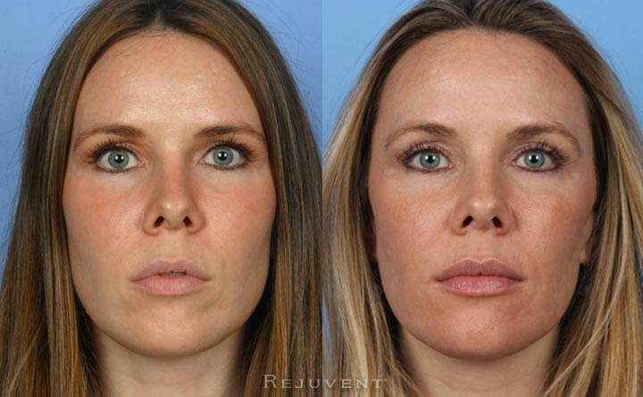 Liquid facelift Frontal view
