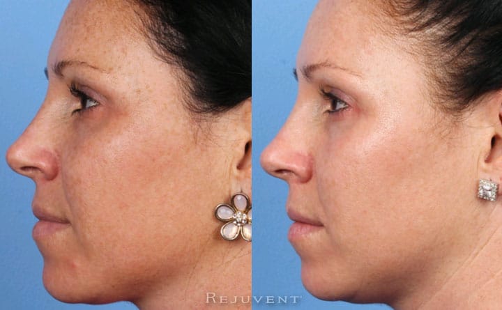Less freckles after Fotofacial