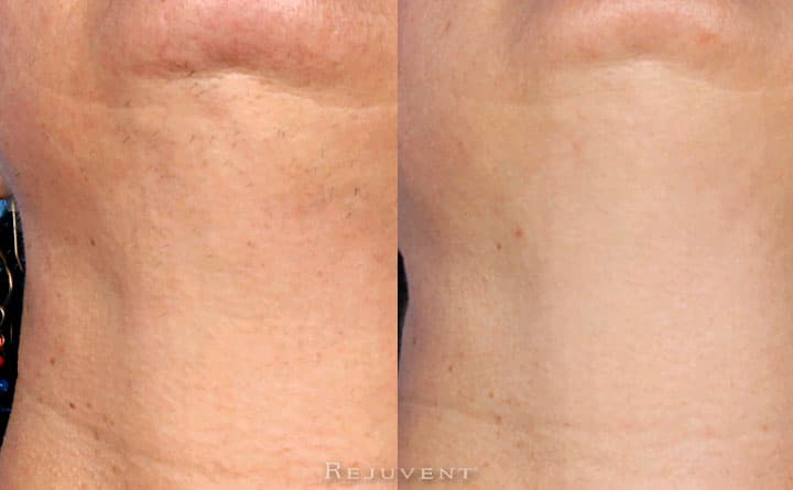 Laser Hair Removal Amazing chin area results