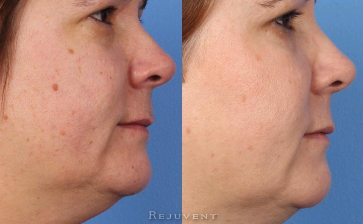 Fotofacial made a huge difference in my skin