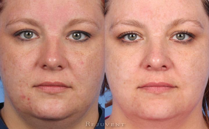 Chemical Peel amazing results