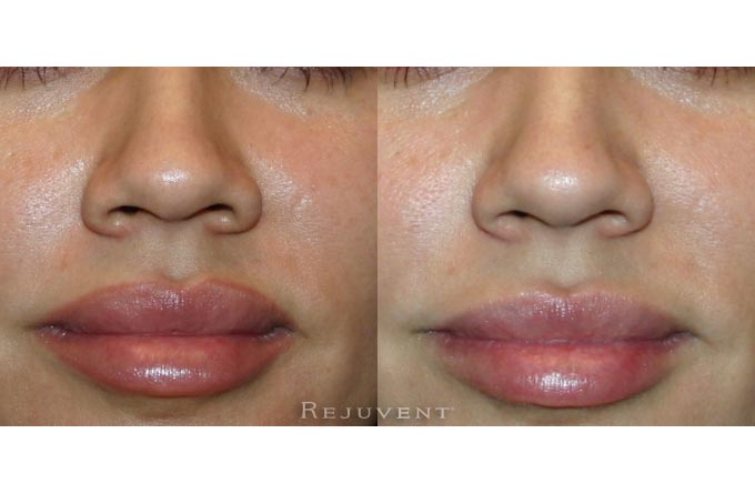 Rhinoplasty Surgery Closeup Photos • Rejuvent Medical Spa Scottsdale