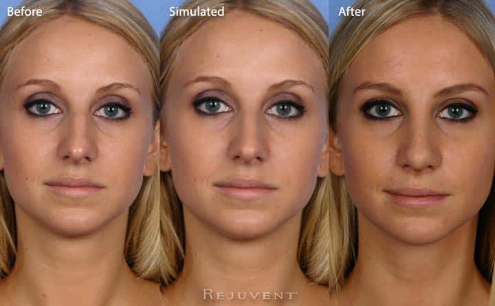 Rhinoplasty Photos At Rejuvent Scottsdale Rejuvent Medical Spa Scottsdale