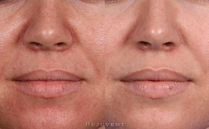 Pore Reduction Photos • Rejuvent Medical Spa Scottsdale