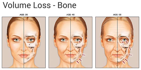 Facial bone loss Deaf woman nake