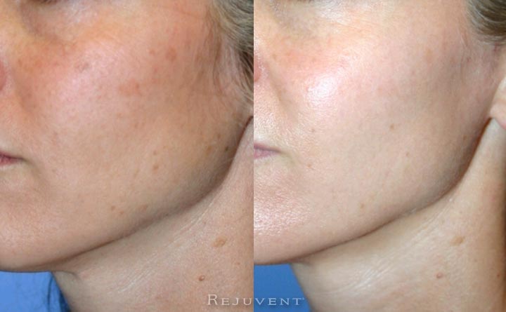 Patient in her 30s skincare results