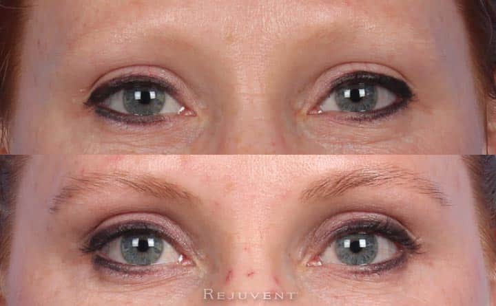 Thinning eyebrows