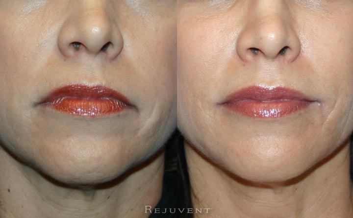 Lip Injection and Xeomin on lips