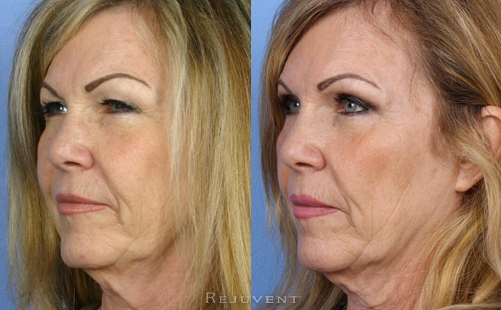 Upper Eyelid surgery Scottsdale