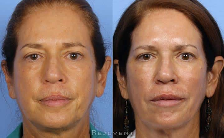 FIllers and Wrinkle Relaxers