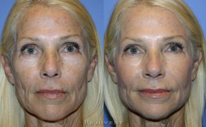 Aging skin before and after