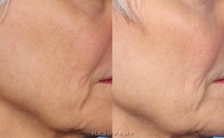 Fotofacial skin texture improvement