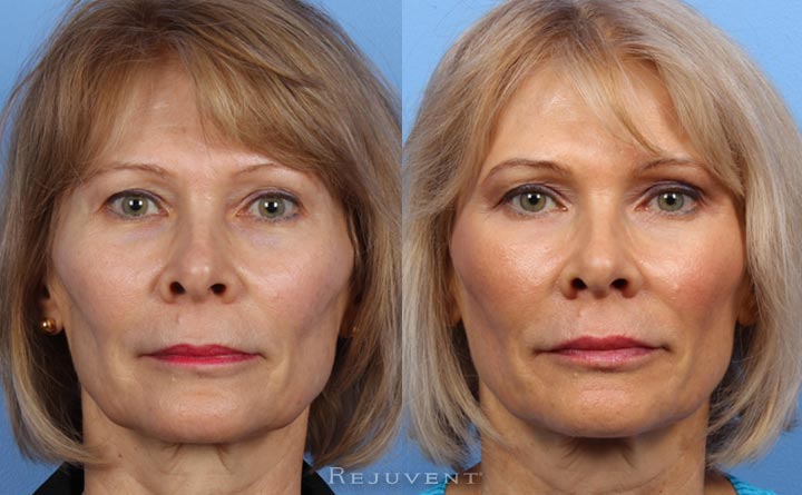 Liquid Facelift natural results